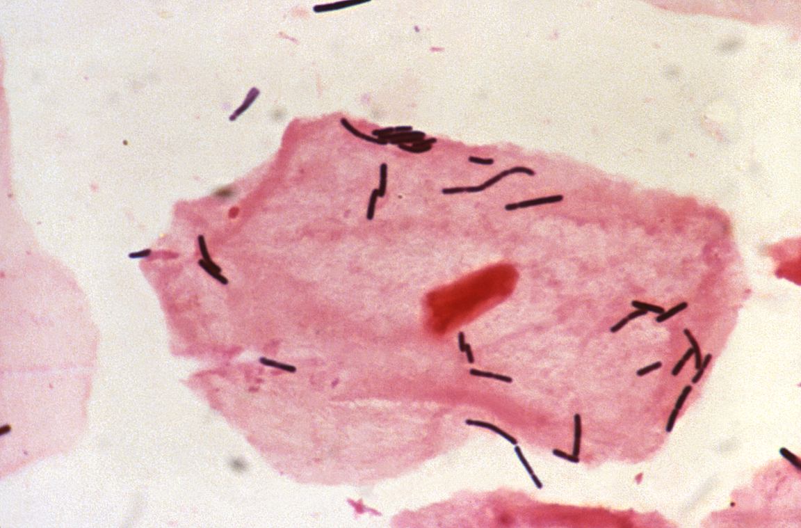 Light micrograph of a Gram-stained vaginal smear: a large pink squamous epithelial cell with a dark red nucleus, with dark purple rod-shaped bacteria lying on and around it.